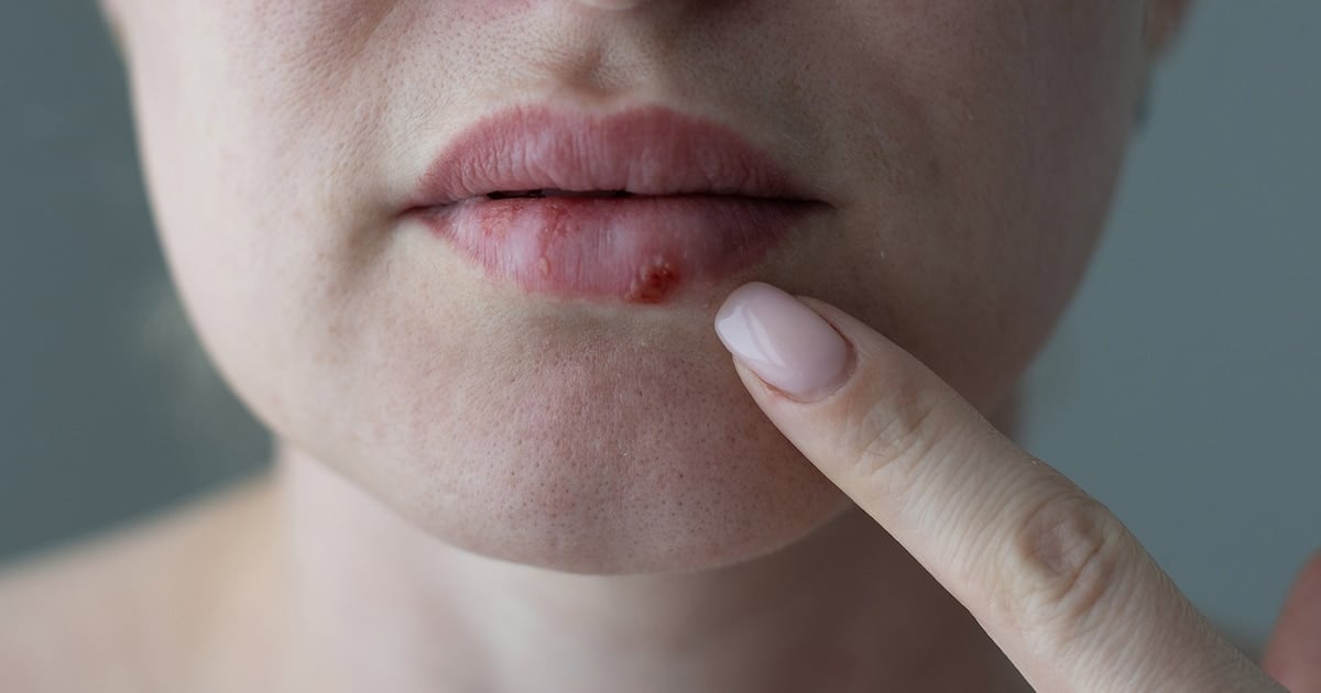 Un paso contra el herpes que se hace resistente: la FDA aprobó un antiviral oral pensado para los casos más difíciles