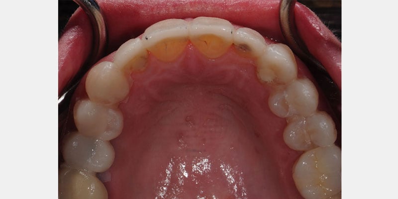 Carillas dentales: la filtración puede comenzar en los bordes